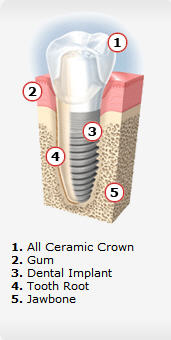 Dental Implant Tooth