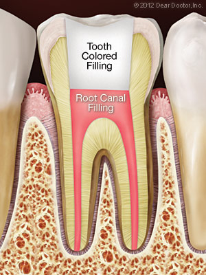 after-root-canal