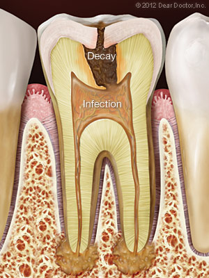tooth-decay-infection