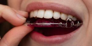 How Long Does Teeth Soreness Last After Retainers? A Guide to